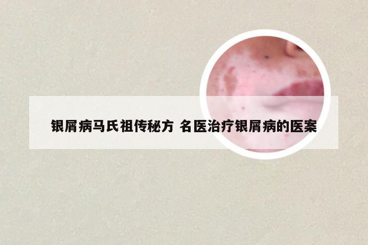 银屑病马氏祖传秘方 名医治疗银屑病的医案