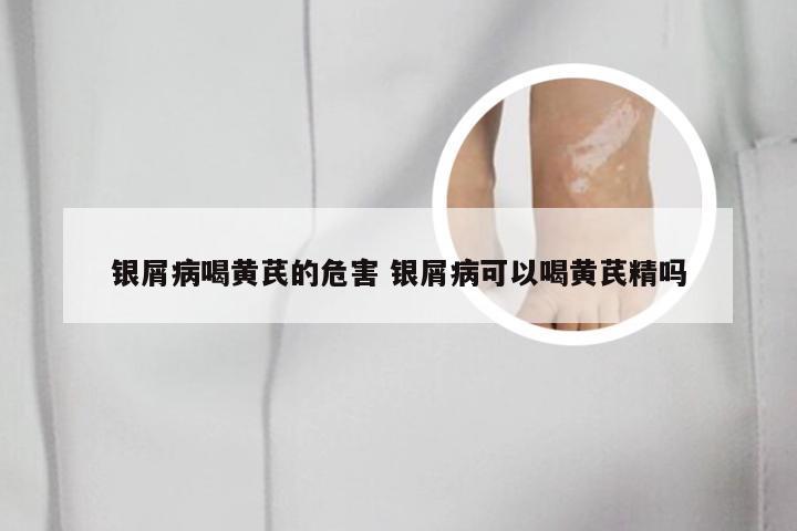 银屑病喝黄芪的危害 银屑病可以喝黄芪精吗