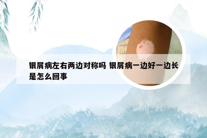 银屑病左右两边对称吗 银屑病一边好一边长是怎么回事