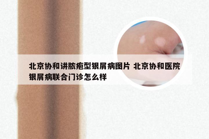 北京协和讲脓疱型银屑病图片 北京协和医院银屑病联合门诊怎么样