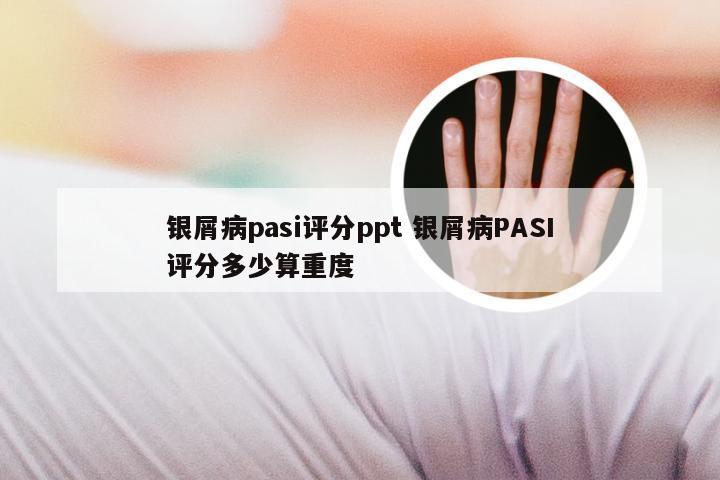 银屑病pasi评分ppt 银屑病PASI评分多少算重度