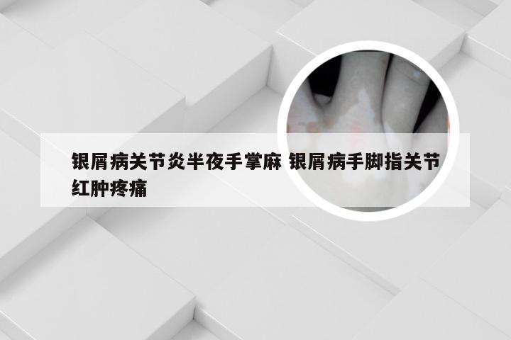 银屑病关节炎半夜手掌麻 银屑病手脚指关节红肿疼痛