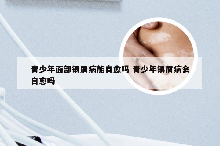 青少年面部银屑病能自愈吗 青少年银屑病会自愈吗