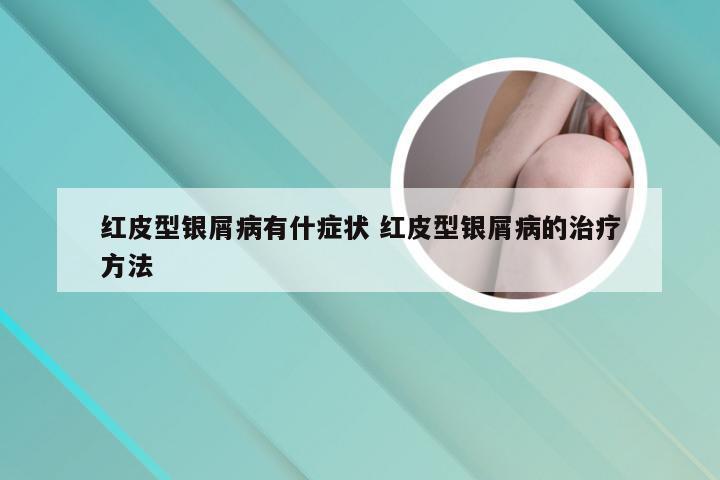 红皮型银屑病有什症状 红皮型银屑病的治疗方法
