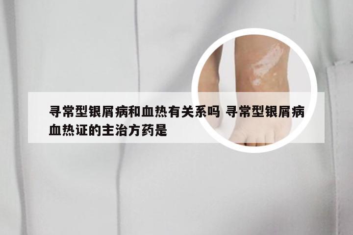 寻常型银屑病和血热有关系吗 寻常型银屑病血热证的主治方药是