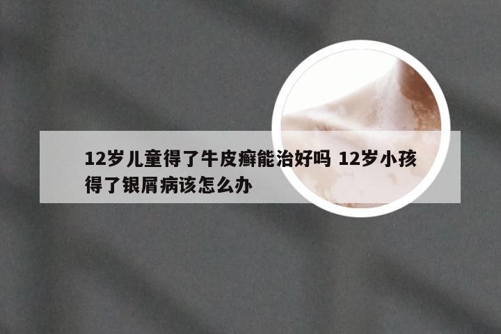 12岁儿童得了牛皮癣能治好吗 12岁小孩得了银屑病该怎么办