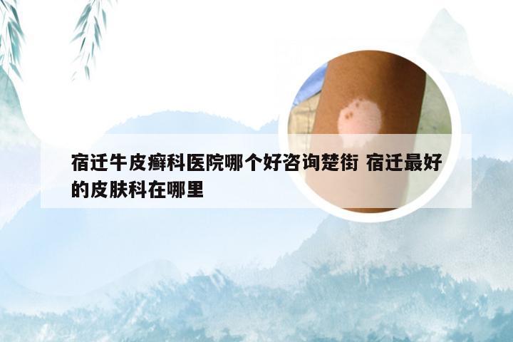 宿迁牛皮癣科医院哪个好咨询楚街 宿迁最好的皮肤科在哪里