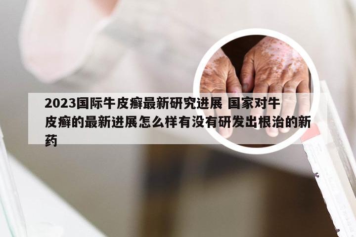2023国际牛皮癣最新研究进展 国家对牛皮癣的最新进展怎么样有没有研发出根治的新药