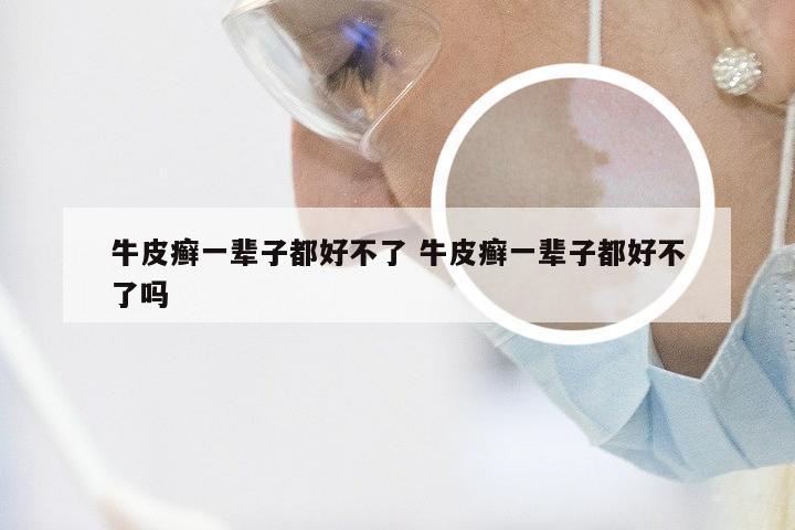 牛皮癣一辈子都好不了 牛皮癣一辈子都好不了吗
