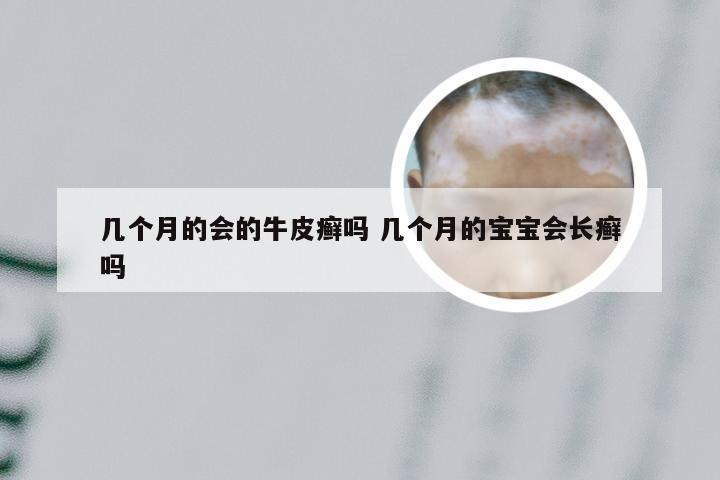 几个月的会的牛皮癣吗 几个月的宝宝会长癣吗