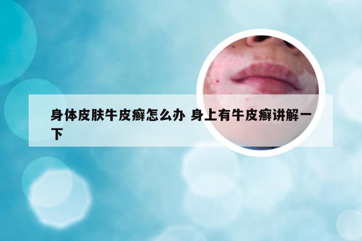 身体皮肤牛皮癣怎么办 身上有牛皮癣讲解一下