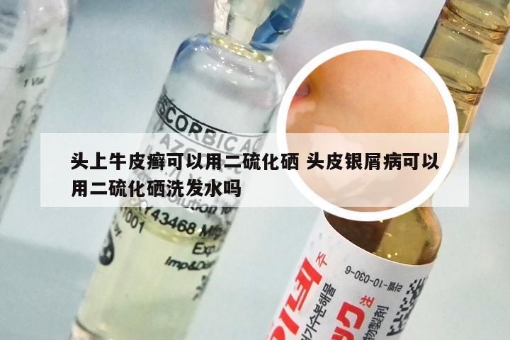 头上牛皮癣可以用二硫化硒 头皮银屑病可以用二硫化硒洗发水吗