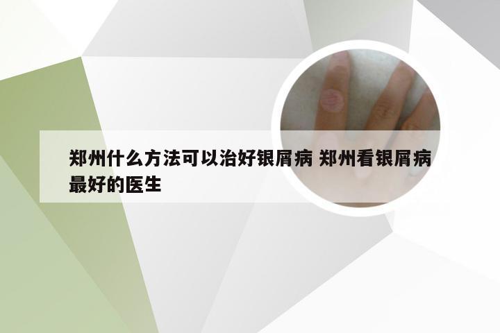 郑州什么方法可以治好银屑病 郑州看银屑病最好的医生