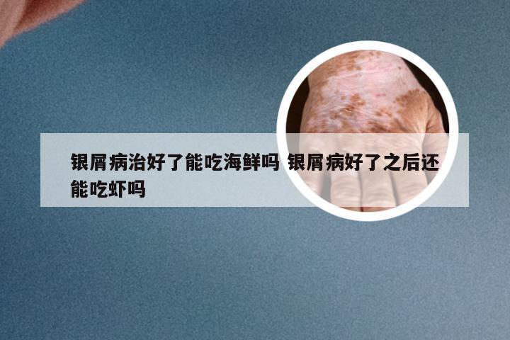 银屑病治好了能吃海鲜吗 银屑病好了之后还能吃虾吗