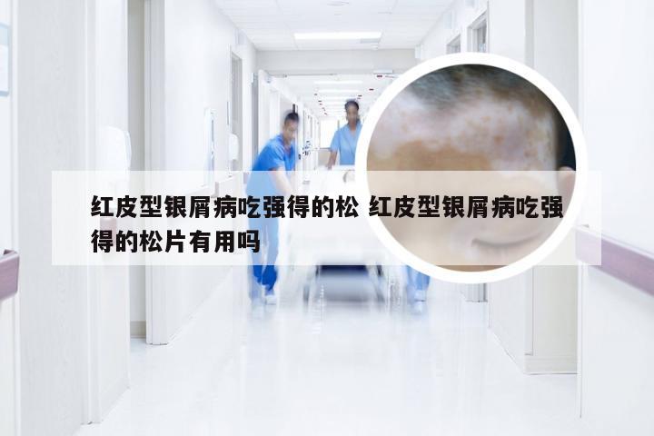 红皮型银屑病吃强得的松 红皮型银屑病吃强得的松片有用吗