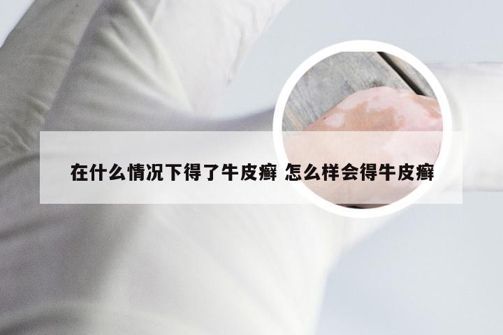 在什么情况下得了牛皮癣 怎么样会得牛皮癣