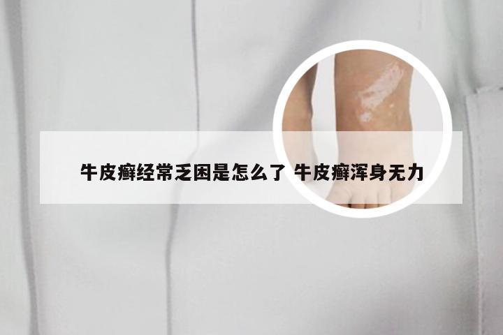 牛皮癣经常乏困是怎么了 牛皮癣浑身无力