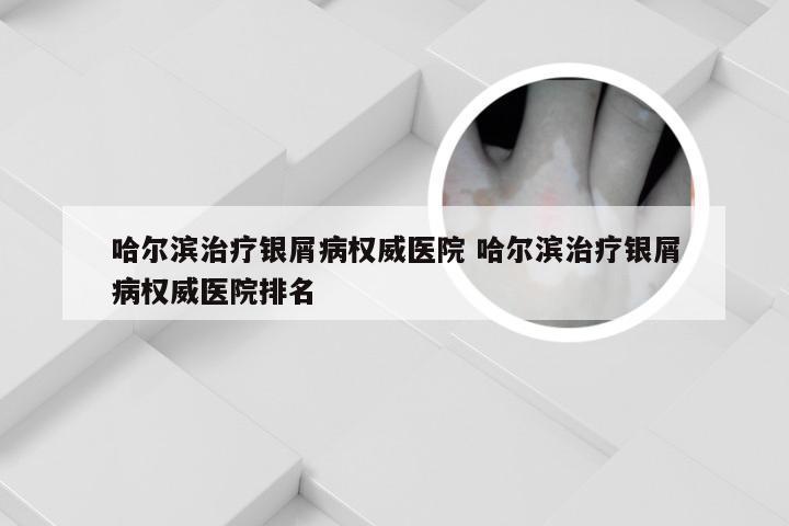 哈尔滨治疗银屑病权威医院 哈尔滨治疗银屑病权威医院排名
