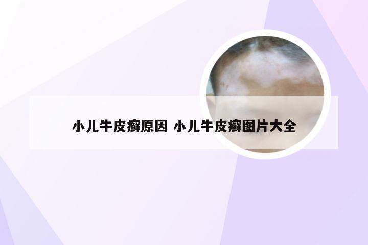 小儿牛皮癣原因 小儿牛皮癣图片大全