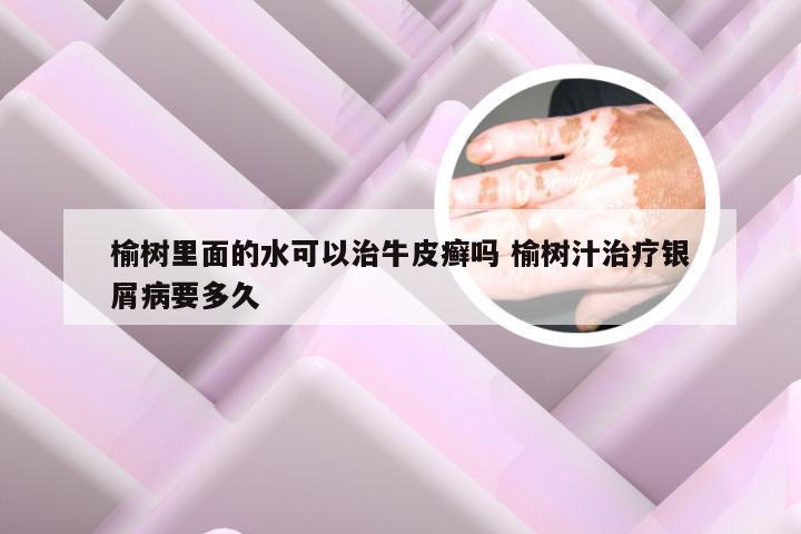 榆树里面的水可以治牛皮癣吗 榆树汁治疗银屑病要多久