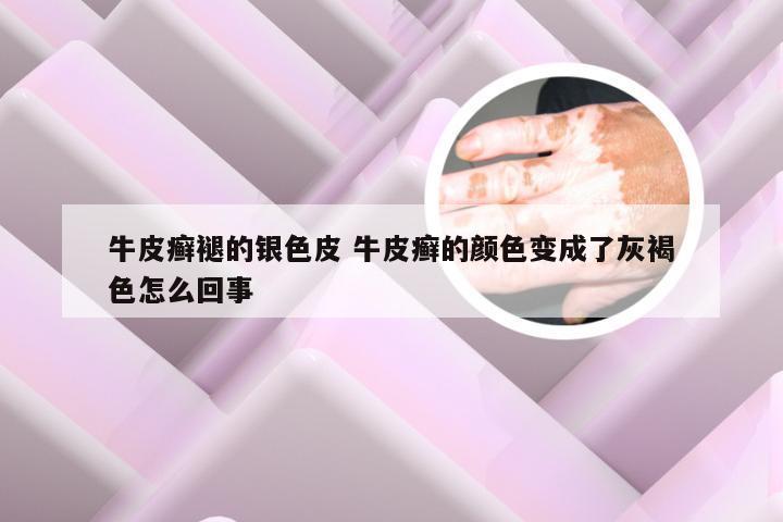 牛皮癣褪的银色皮 牛皮癣的颜色变成了灰褐色怎么回事