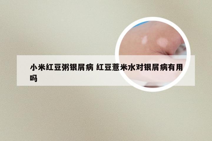 小米红豆粥银屑病 红豆薏米水对银屑病有用吗