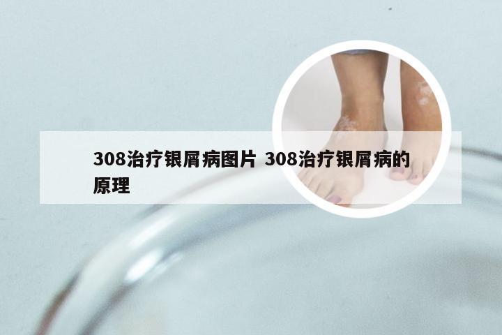 308治疗银屑病图片 308治疗银屑病的原理