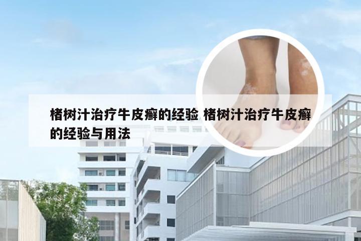 楮树汁治疗牛皮癣的经验 楮树汁治疗牛皮癣的经验与用法