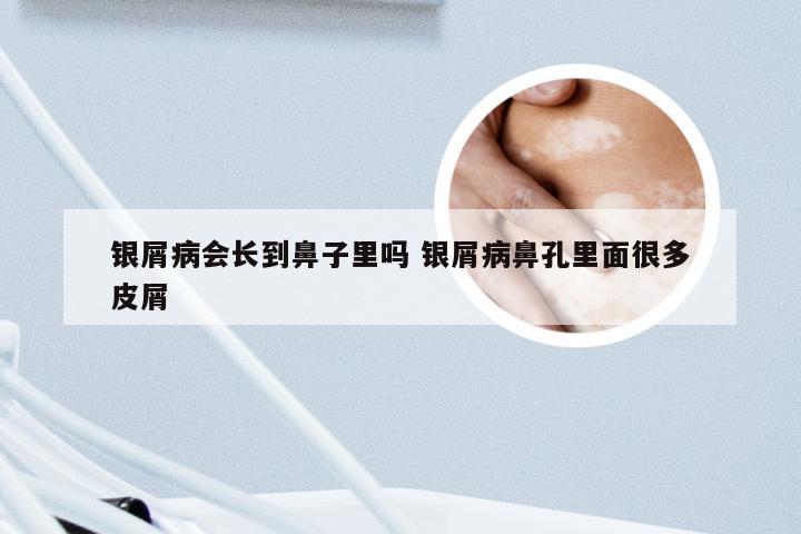 银屑病会长到鼻子里吗 银屑病鼻孔里面很多皮屑