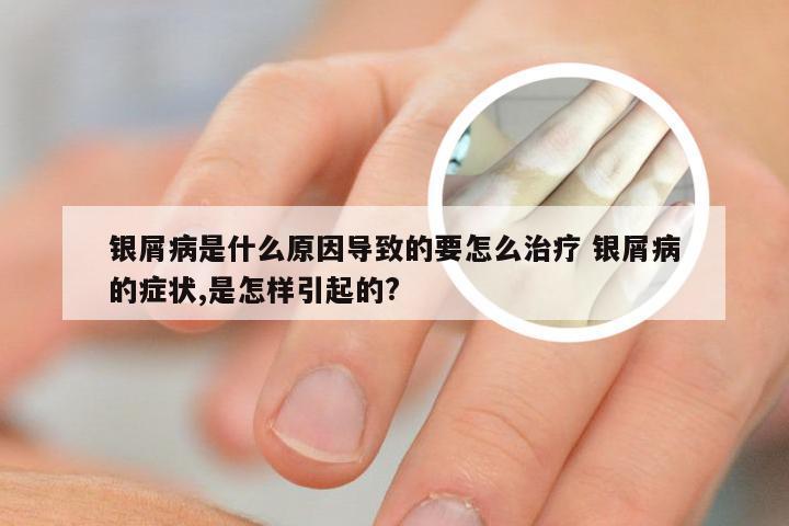 银屑病是什么原因导致的要怎么治疗 银屑病的症状,是怎样引起的?