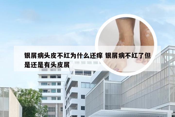 银屑病头皮不红为什么还痒 银屑病不红了但是还是有头皮屑
