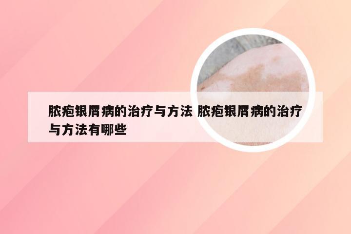 脓疱银屑病的治疗与方法 脓疱银屑病的治疗与方法有哪些