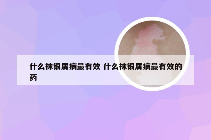 什么抹银屑病最有效 什么抹银屑病最有效的药