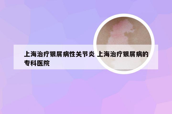 上海治疗银屑病性关节炎 上海治疗银屑病的专科医院