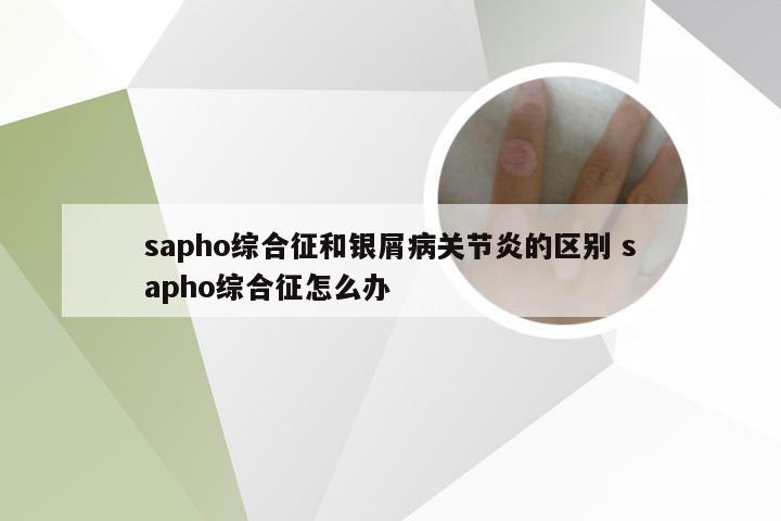 sapho综合征和银屑病关节炎的区别 sapho综合征怎么办