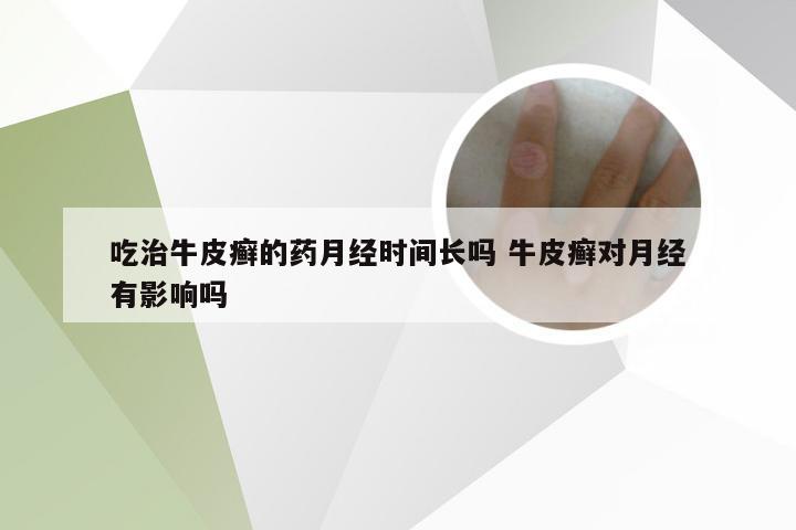 吃治牛皮癣的药月经时间长吗 牛皮癣对月经有影响吗