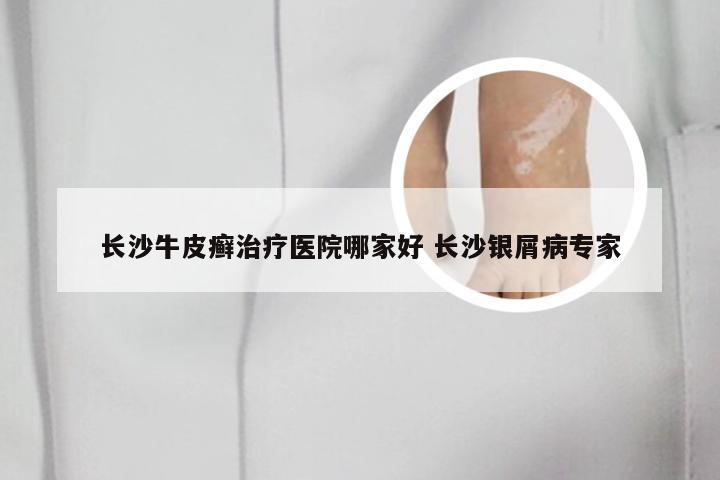 长沙牛皮癣治疗医院哪家好 长沙银屑病专家