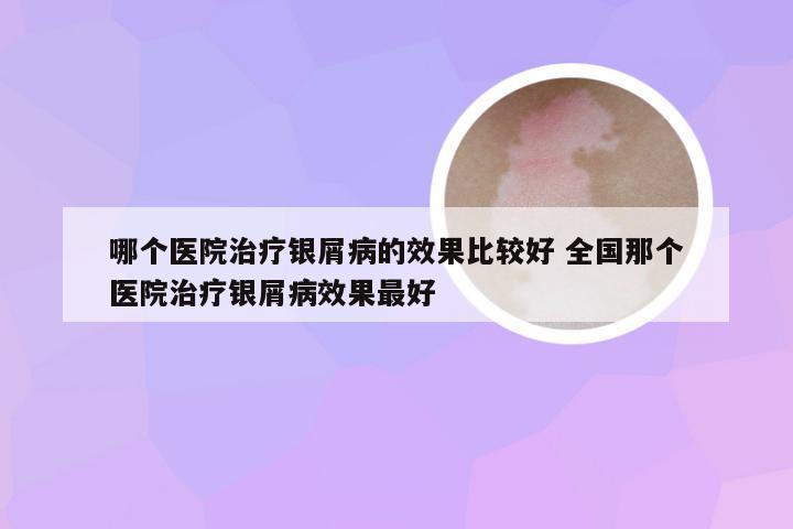 哪个医院治疗银屑病的效果比较好 全国那个医院治疗银屑病效果最好