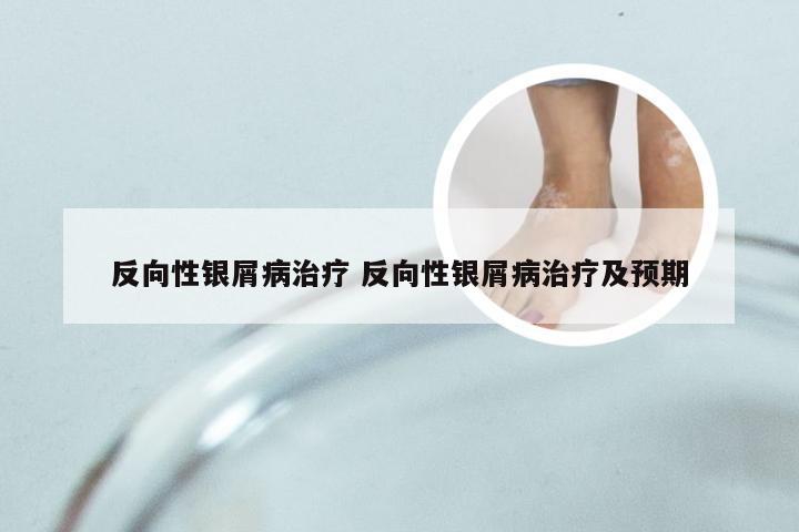 反向性银屑病治疗 反向性银屑病治疗及预期