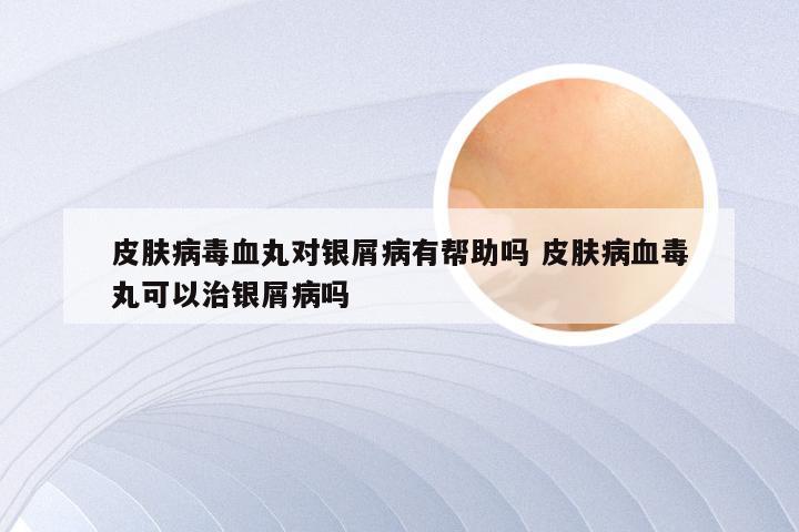 皮肤病毒血丸对银屑病有帮助吗 皮肤病血毒丸可以治银屑病吗