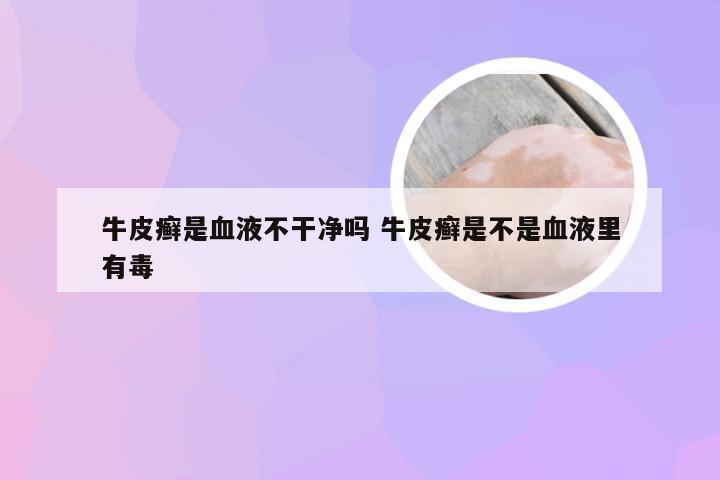 牛皮癣是血液不干净吗 牛皮癣是不是血液里有毒