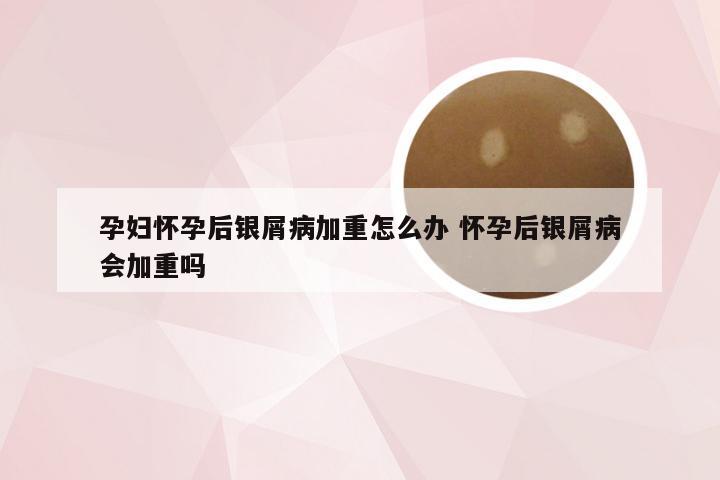 孕妇怀孕后银屑病加重怎么办 怀孕后银屑病会加重吗