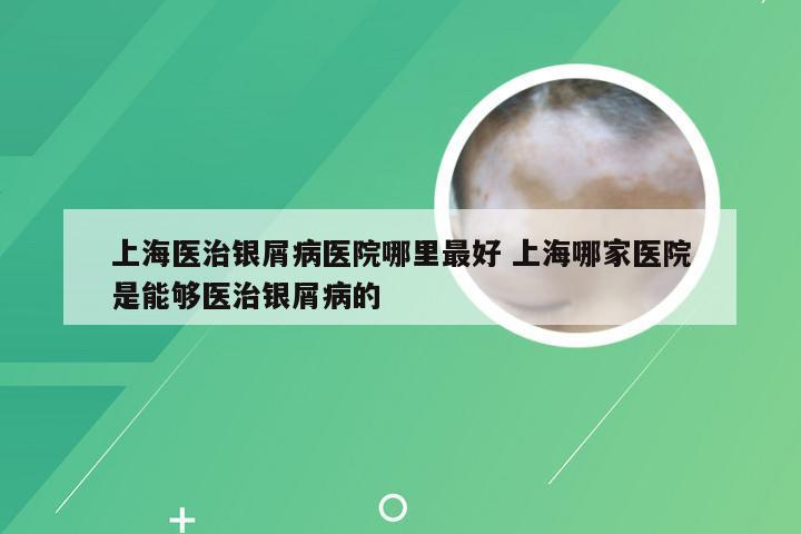 上海医治银屑病医院哪里最好 上海哪家医院是能够医治银屑病的