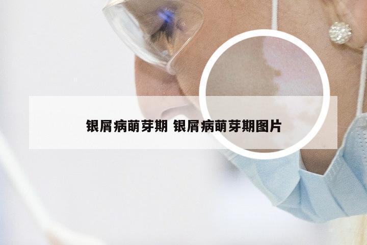 银屑病萌芽期 银屑病萌芽期图片