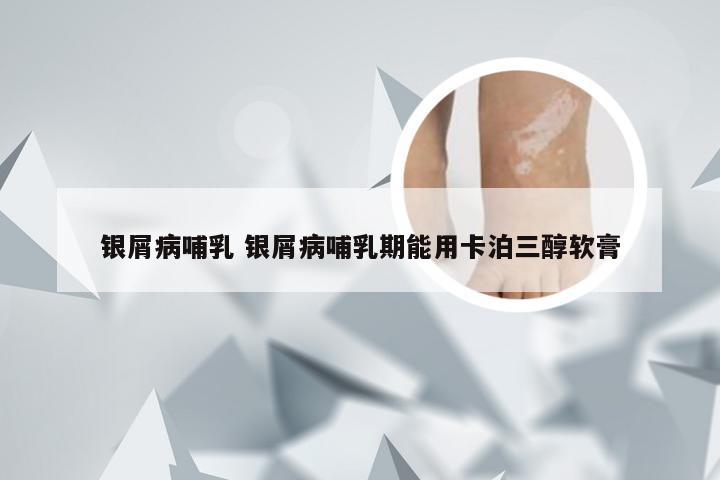 银屑病哺乳 银屑病哺乳期能用卡泊三醇软膏