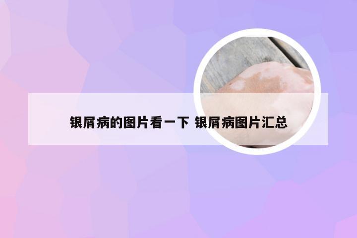银屑病的图片看一下 银屑病图片汇总