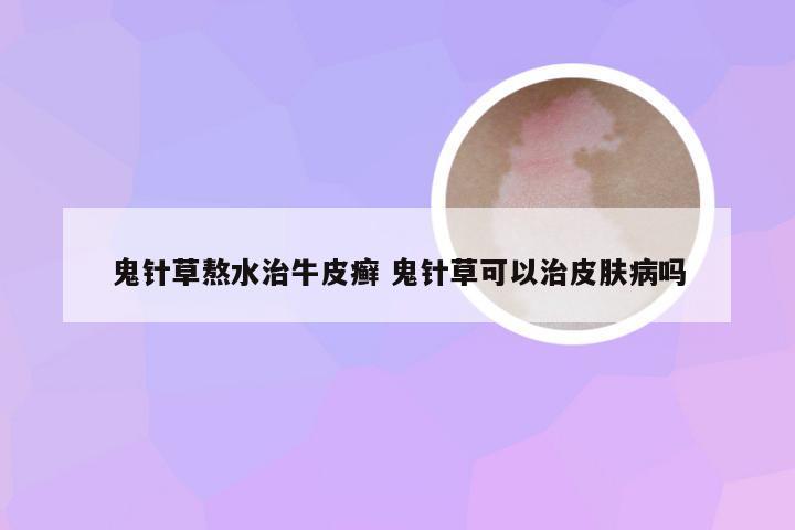 鬼针草熬水治牛皮癣 鬼针草可以治皮肤病吗
