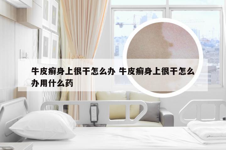 牛皮癣身上很干怎么办 牛皮癣身上很干怎么办用什么药