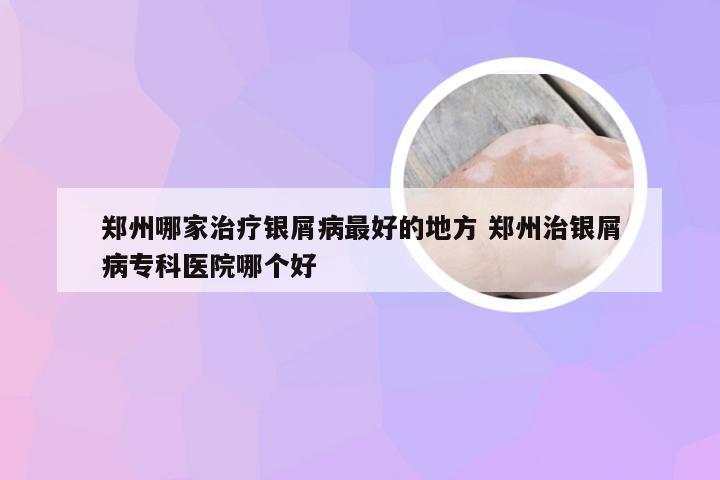 郑州哪家治疗银屑病最好的地方 郑州治银屑病专科医院哪个好