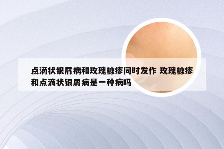 点滴状银屑病和玫瑰糠疹同时发作 玫瑰糠疹和点滴状银屑病是一种病吗